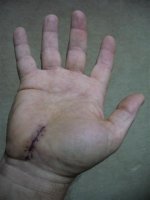 carpal tunnel scar (Small).jpg